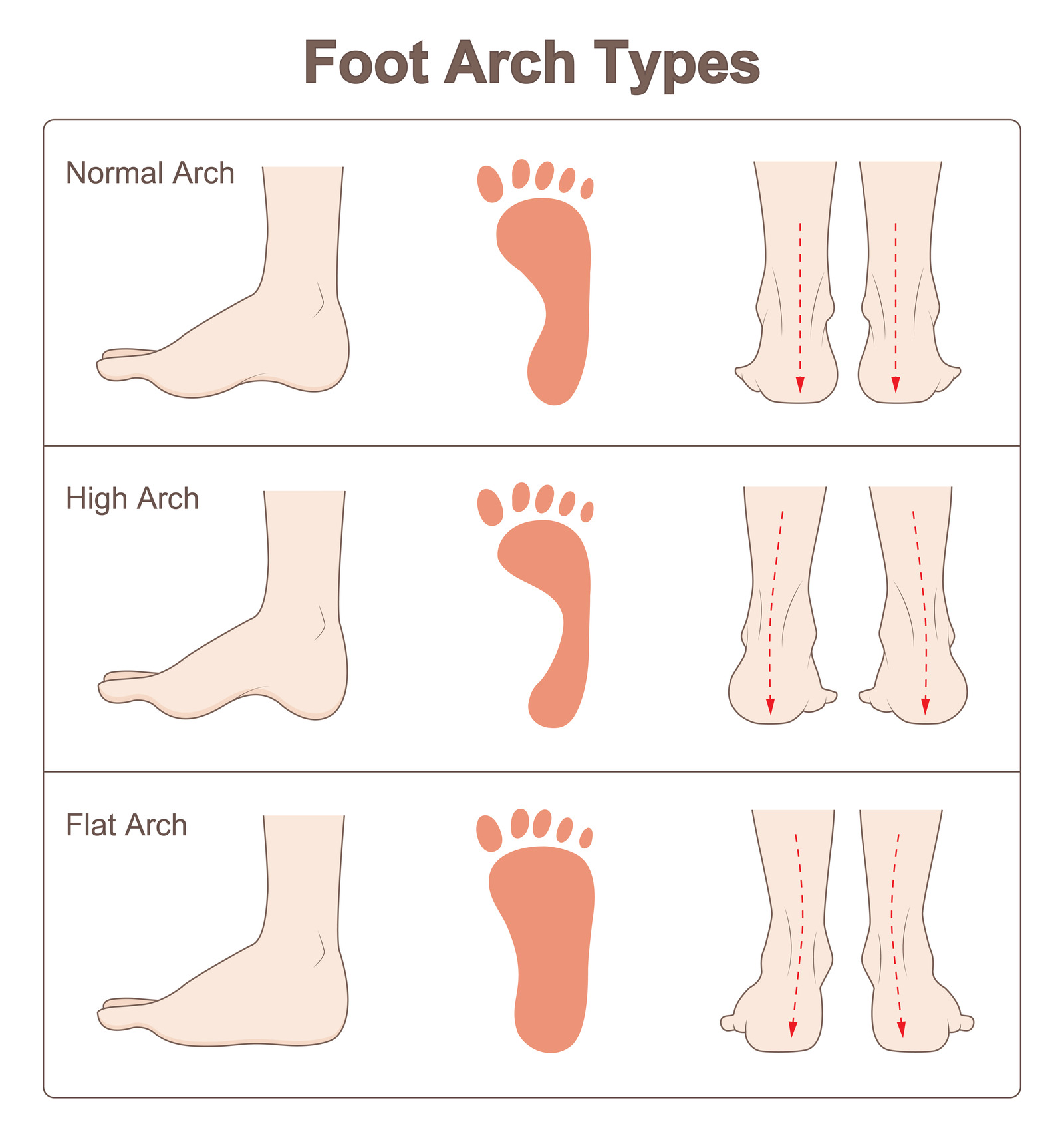 'Foot Arch Types: Normal Arch, High Arch, and Flat Arch.